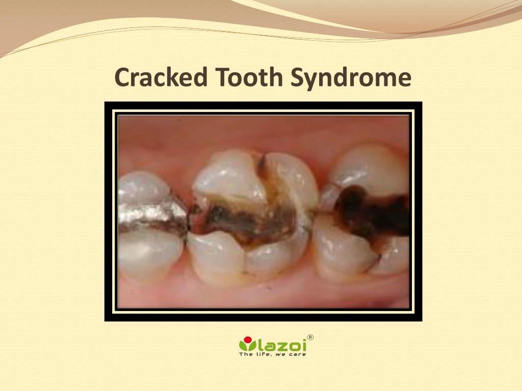 cracked tooth syndrome