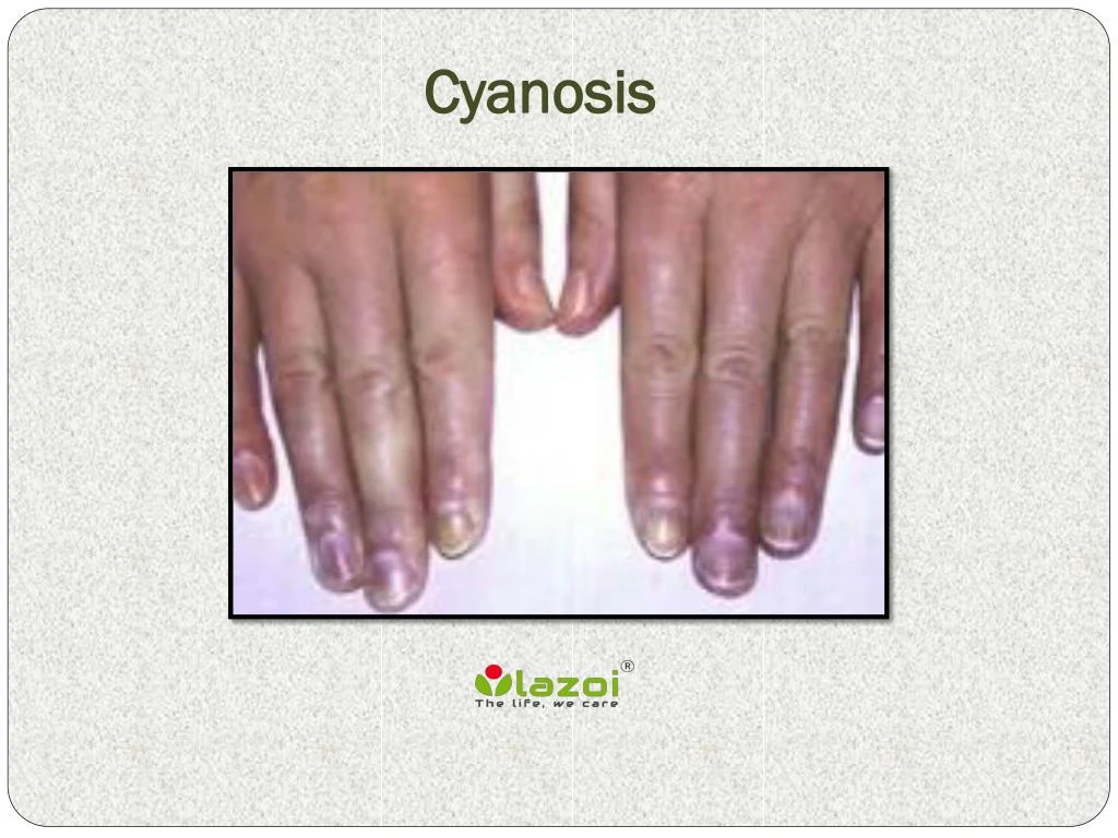 cyanosis