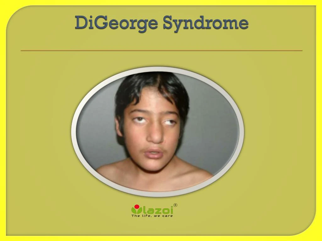 digeorge syndrome