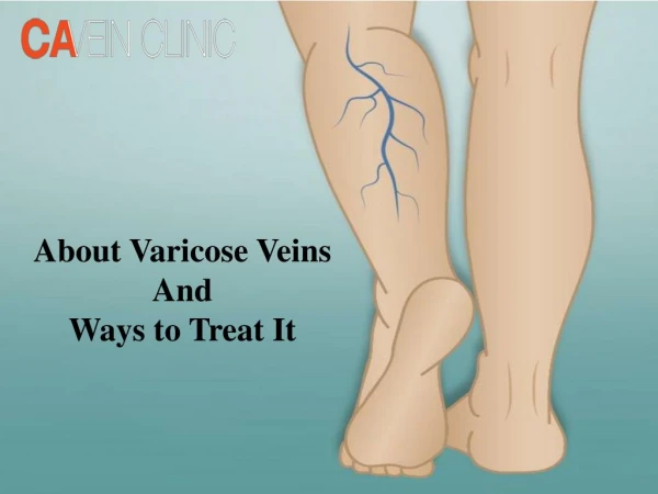 Ways to Treat Varicose Veins