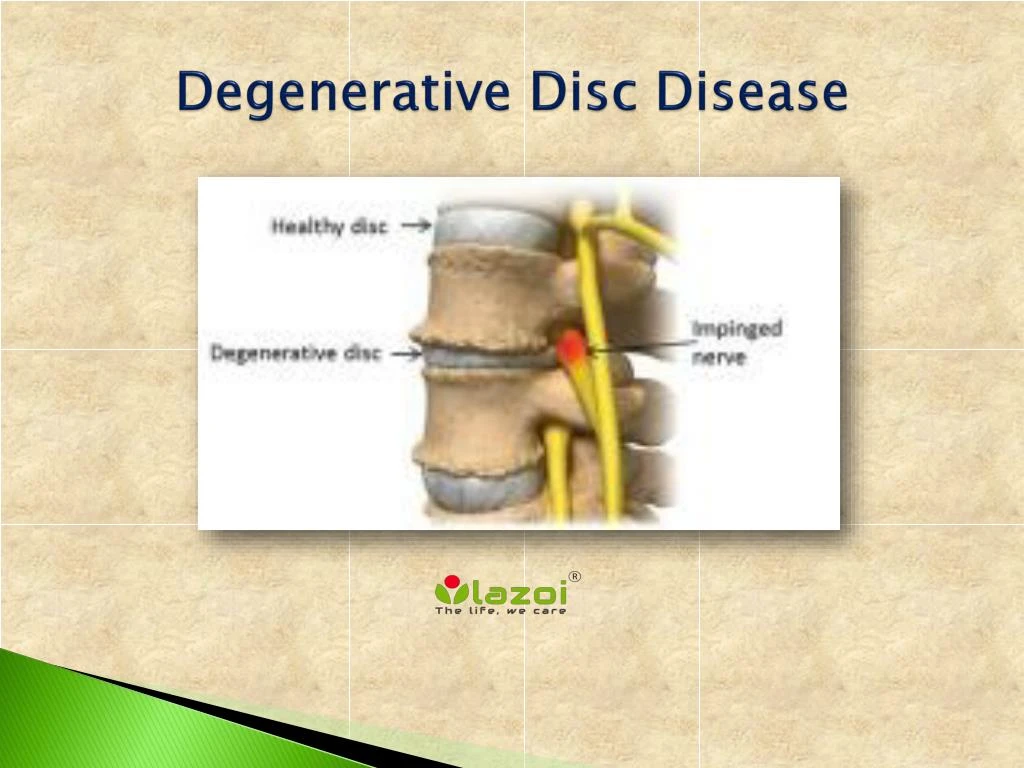 degenerative disc disease