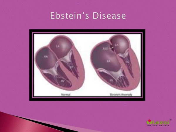 Ebstein’s Disease