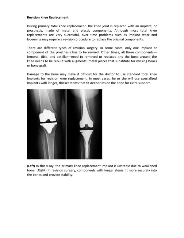 Revision Knee Replacement Surgery pdf | Shri Ramchandra Joint Relacement Centre in Guntur | Vijayawada | Prakasam | A