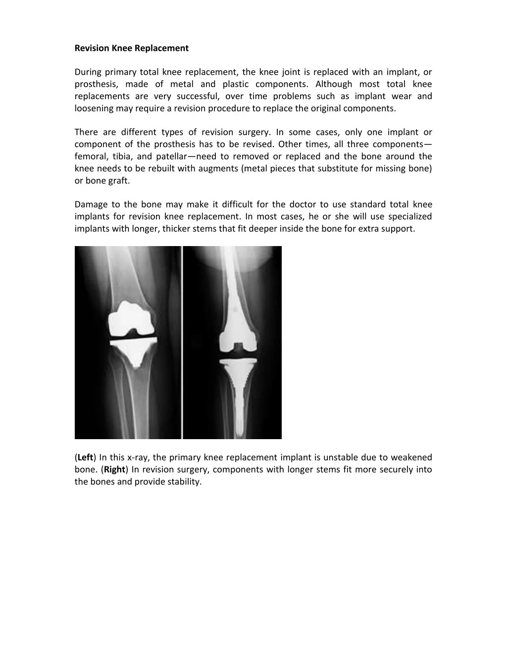 revision knee replacement