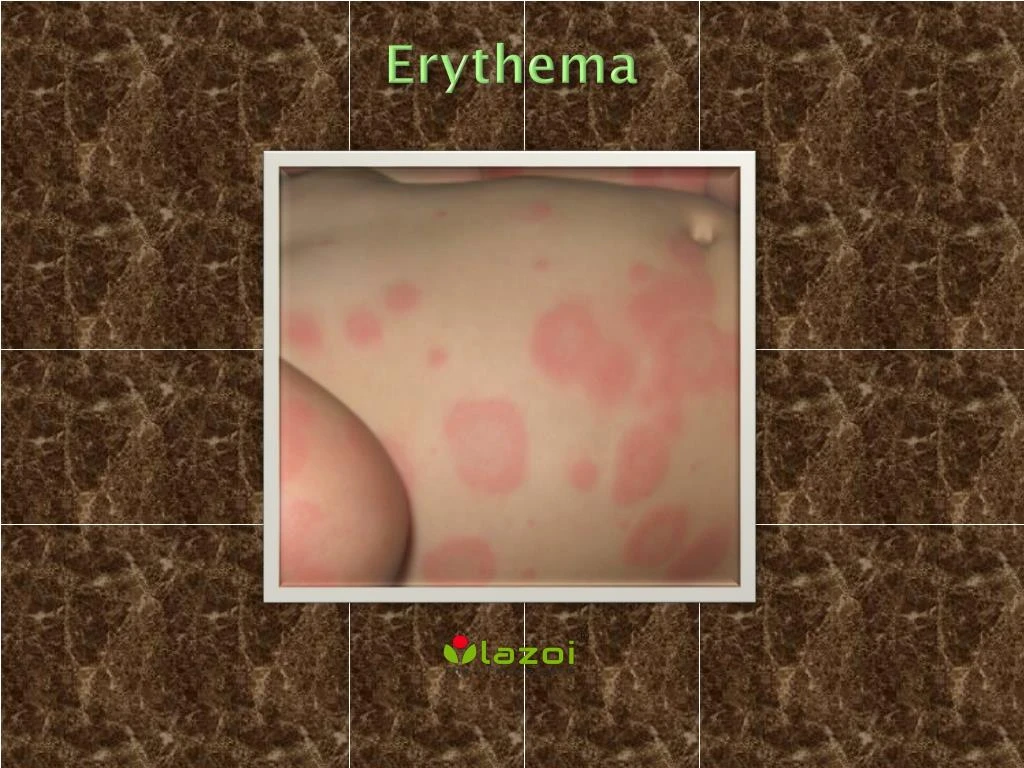 erythema