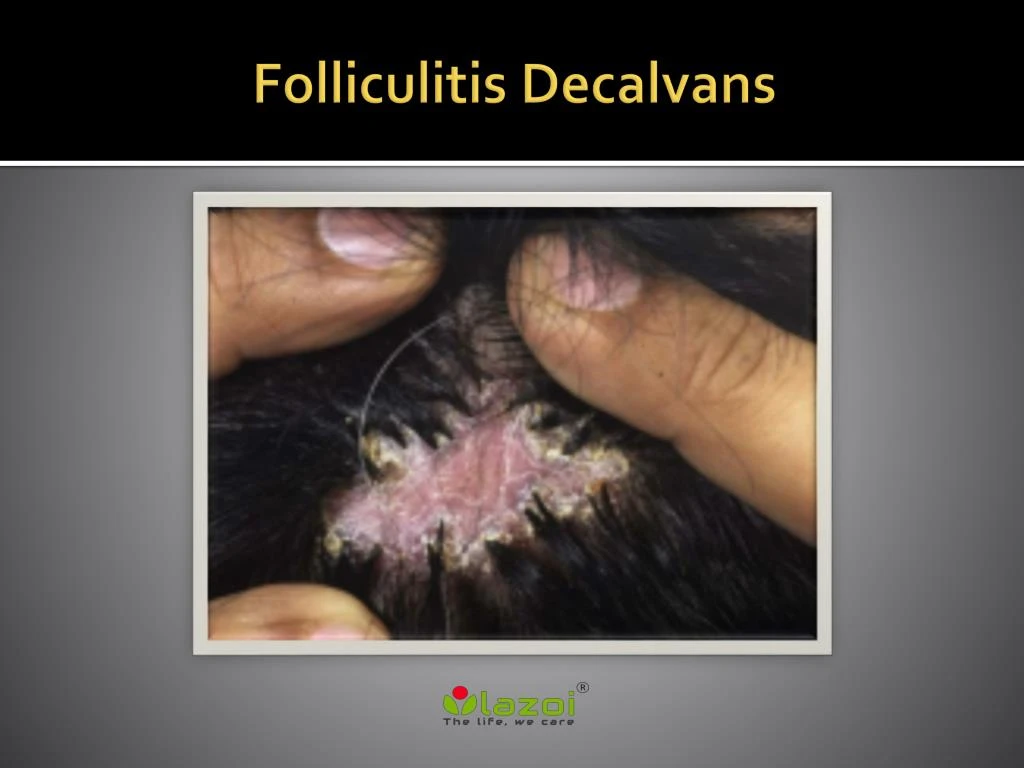 folliculitis decalvans