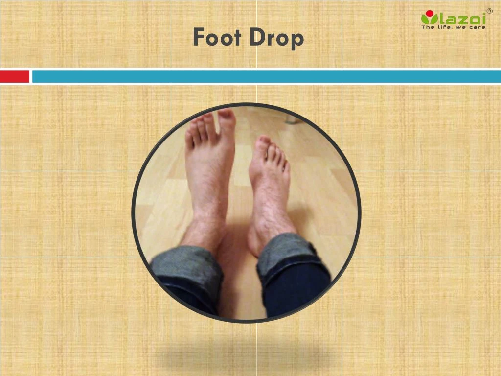 foot drop