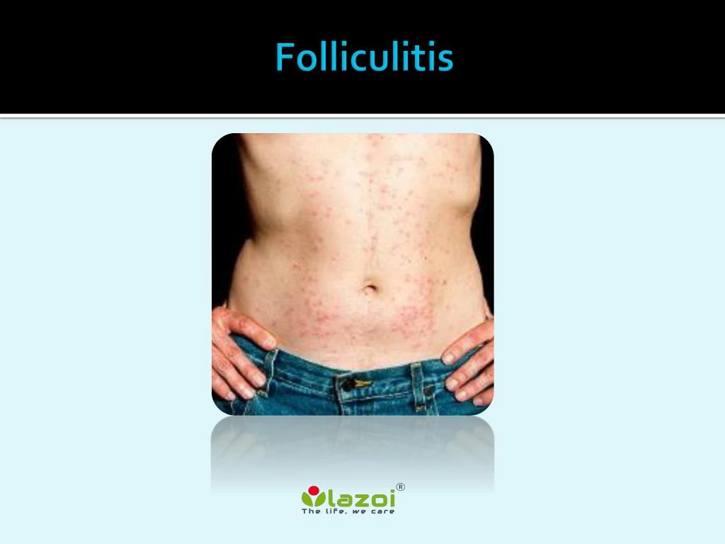 folliculitis