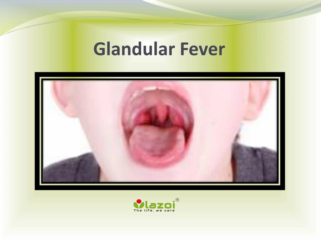 glandular fever