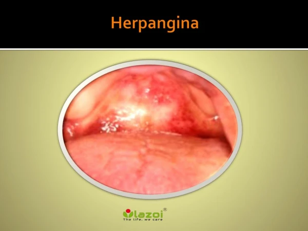 Herpangina