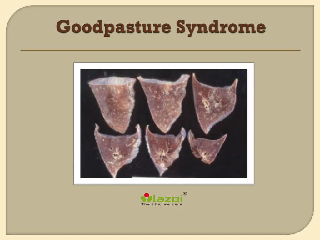 goodpasture syndrome