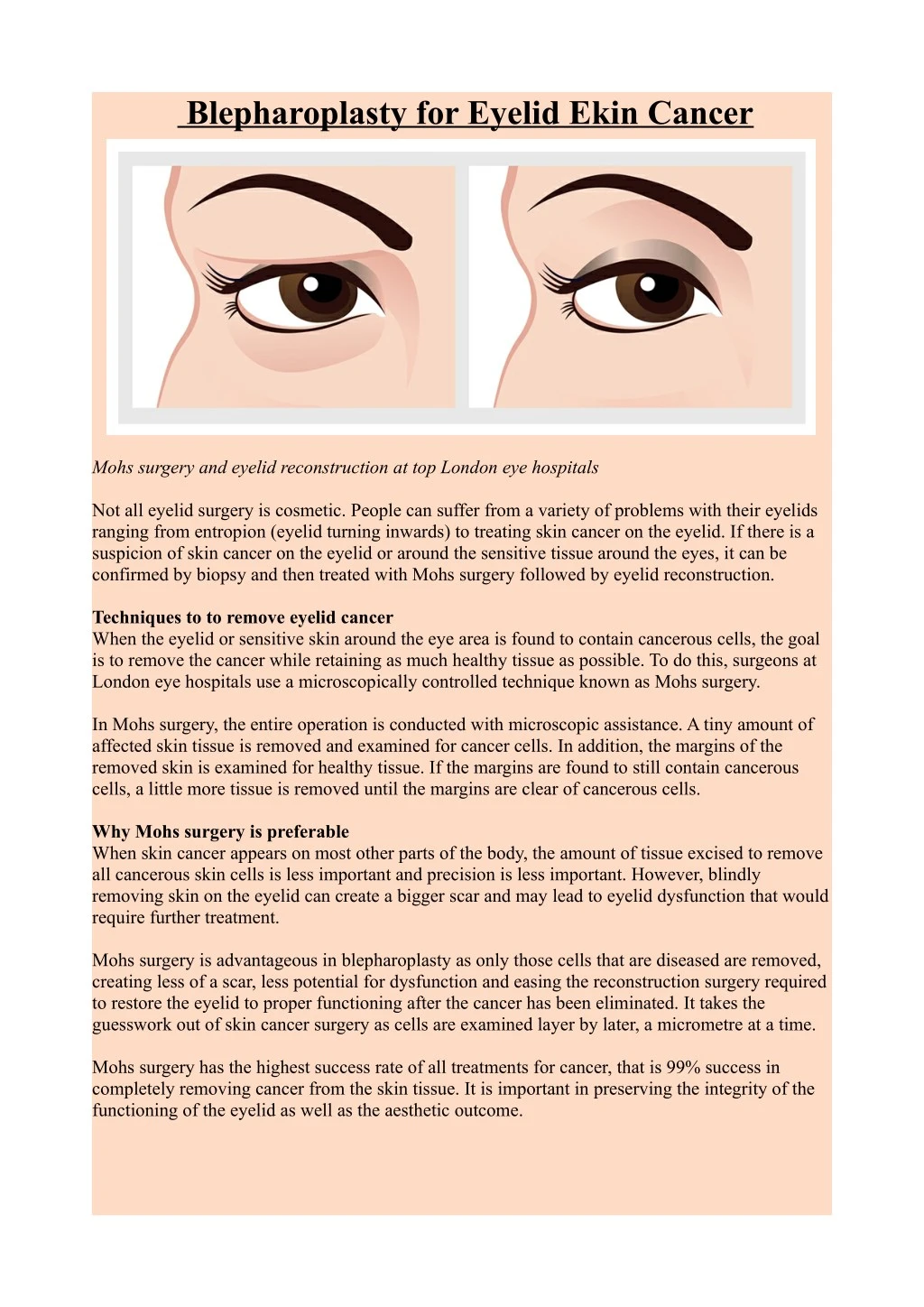 blepharoplasty for eyelid ekin cancer
