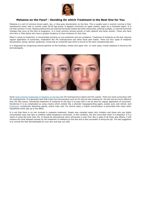 Melasma on the Face? - Deciding On which Treatment is the Best One for You