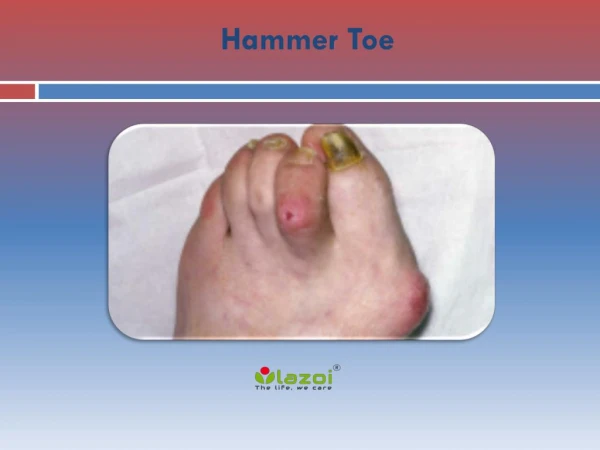 Hammer Toe