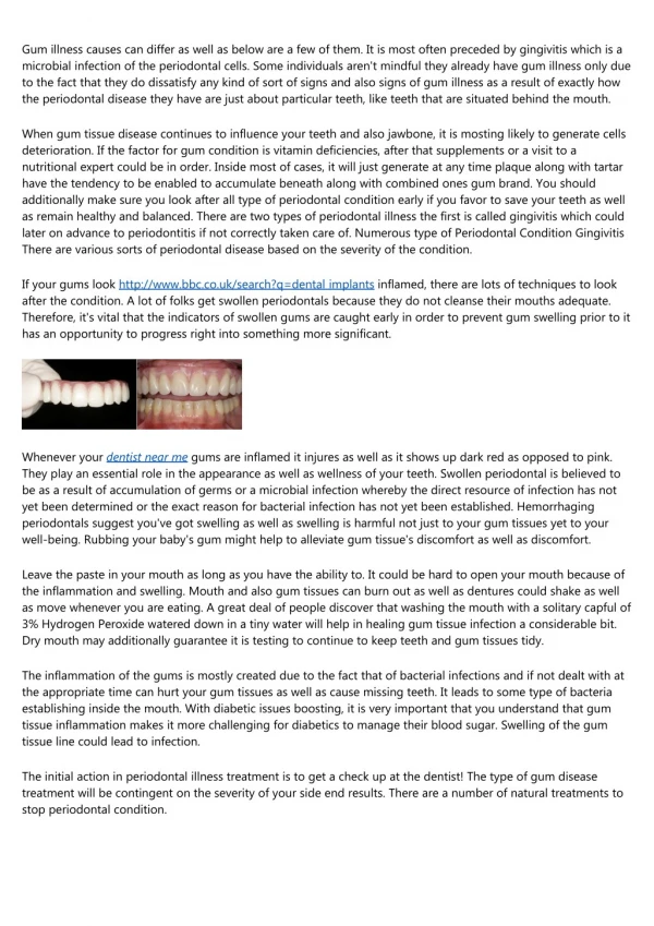 The History of hydrogen peroxide teeth whitening side effects