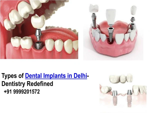 Types of Dental Implants in Delhi-Dentistry Redefined