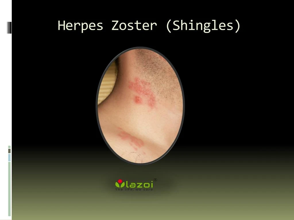 herpes zoster shingles