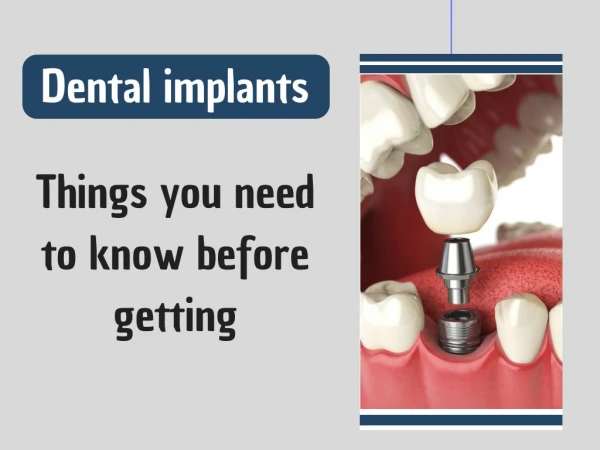 Things You Need to Know Before Getting Implants