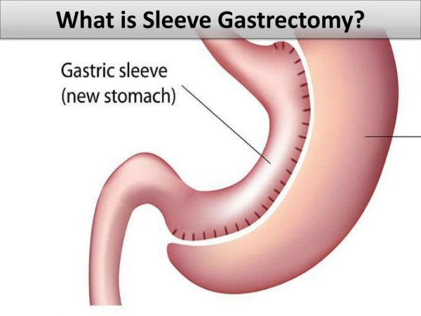 What is Sleeve Gastrectomy?