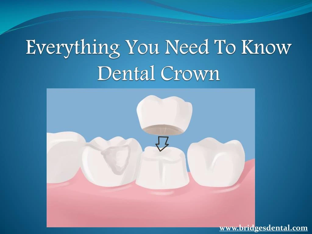 everything you need to know dental crown