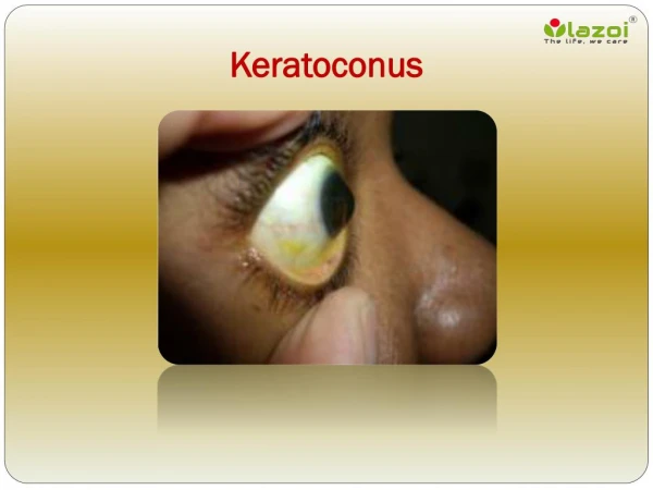 Keratoconus: Causes, Symptoms, Daignosis, Prevention and Treatment