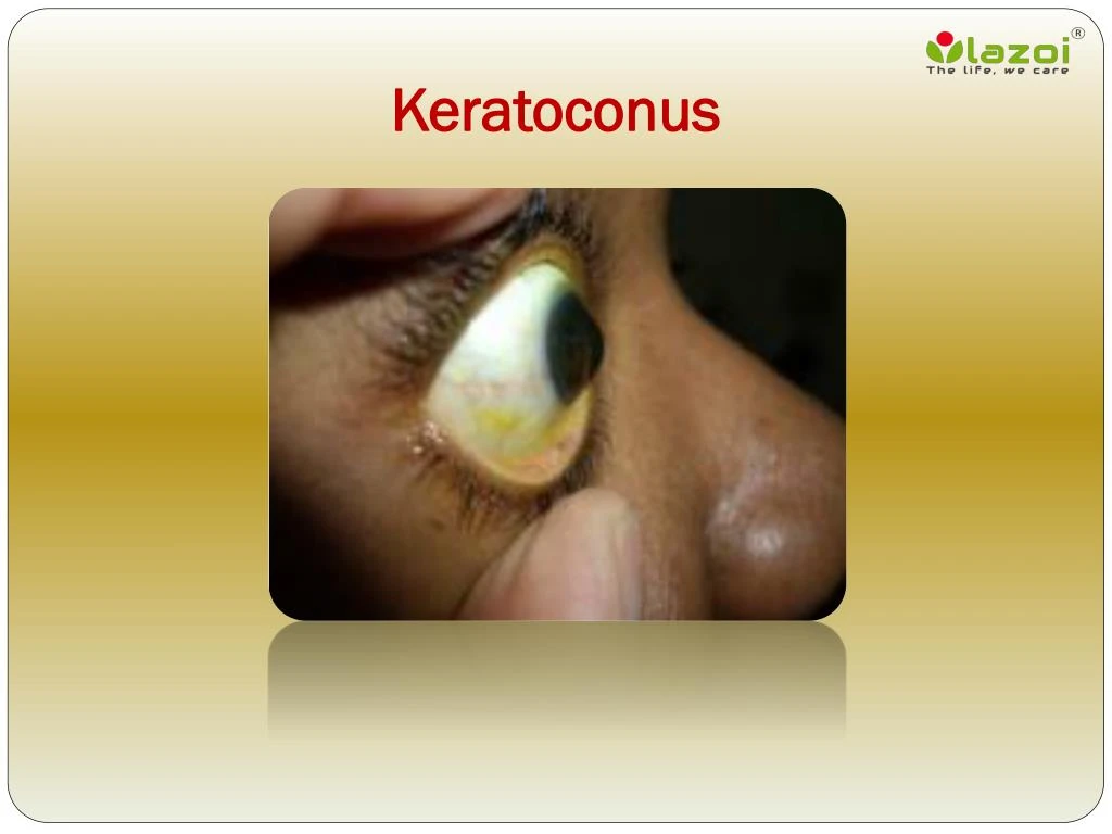 keratoconus