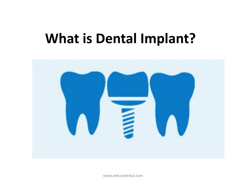 what is dental implant