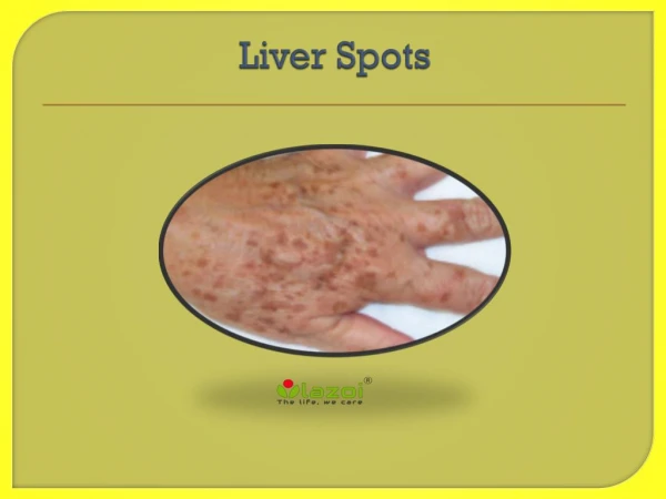 Liver Spots : Causes, Symptoms, Daignosis, Prevention and Treatment