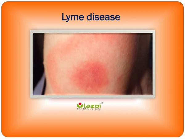 Lyme disease : Causes, Symptoms, Daignosis, Prevention and Treatment