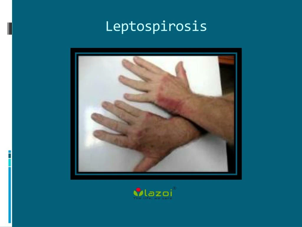 leptospirosis