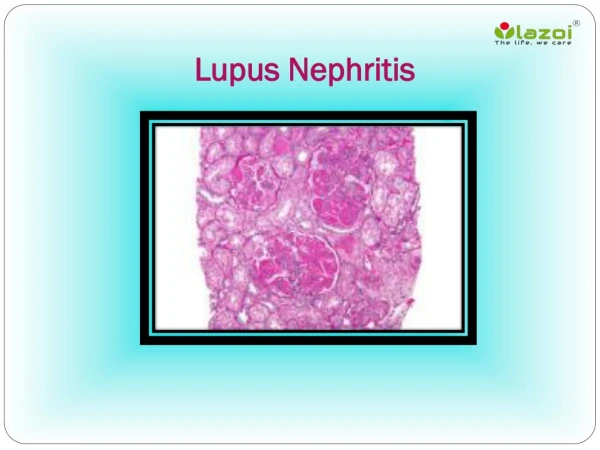 Lupus Nephritis: Causes, Symptoms, Daignosis, Prevention and Treatment