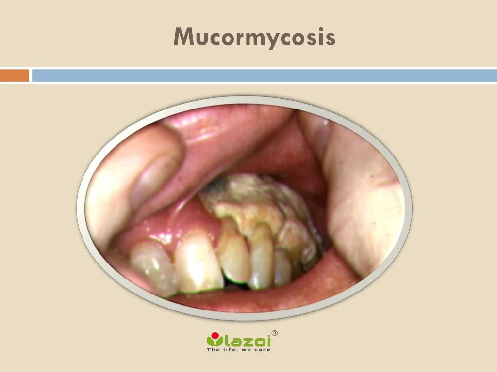 mucormycosis