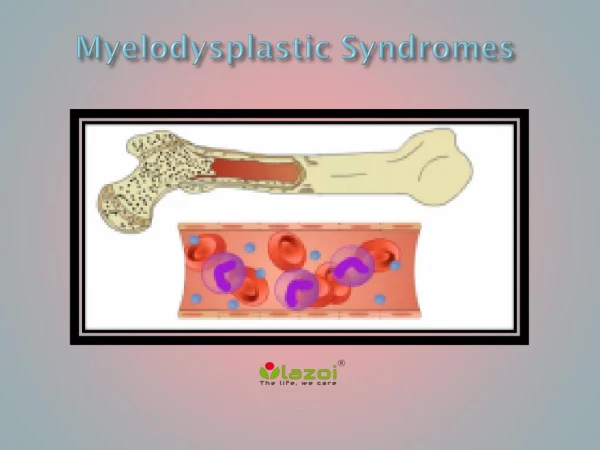 Myelodysplastic Syndromes: Causes, Symptoms, Daignosis, Prevention and Treatment