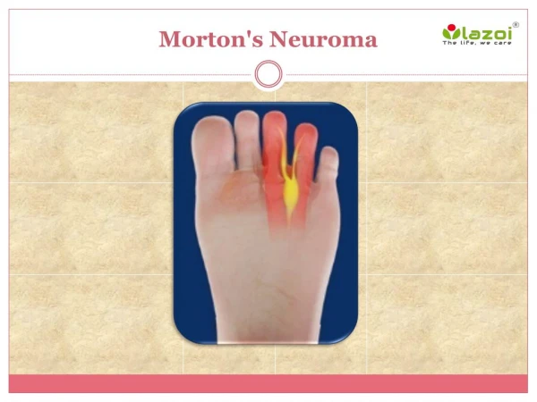 Morton’s Neuroma: Causes, Symptoms, Daignosis, Prevention and Treatment