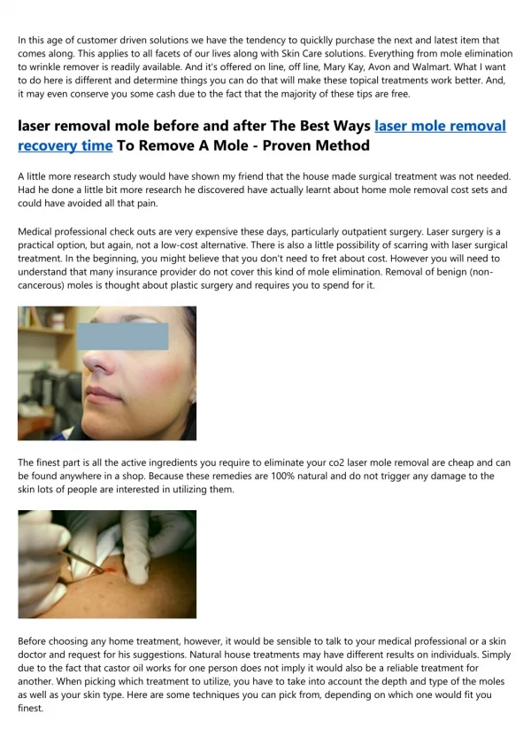 co2laser removal mole cost Mole Removal Methods For A Much Better Looking Skin