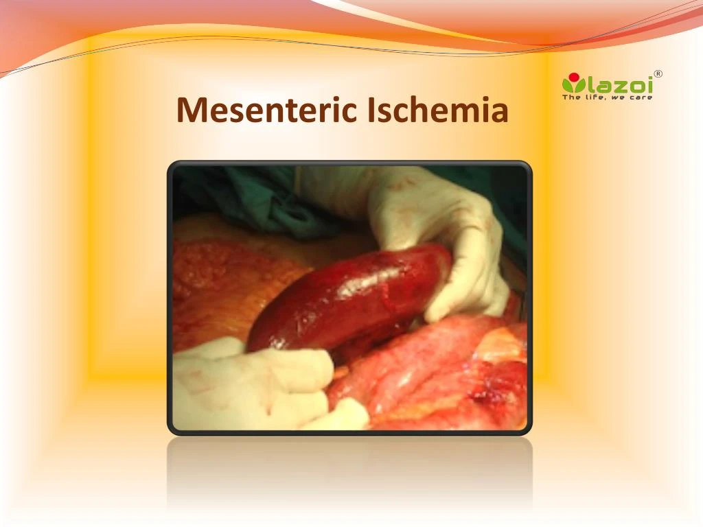mesenteric ischemia