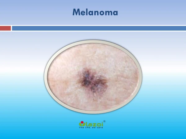 Melanoma: Causes, Symptoms, Daignosis, Prevention and Treatment Melanoma is the most dangerous type of skin cancer and i
