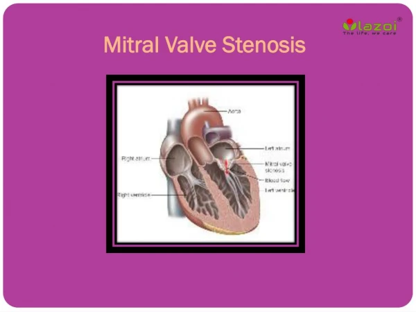 Mitral Valve Stenosis: Causes, Symptoms, Daignosis, Prevention and Treatment