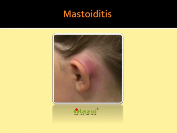 Mastoiditis: Causes, Symptoms, Daignosis, Prevention and Treatment