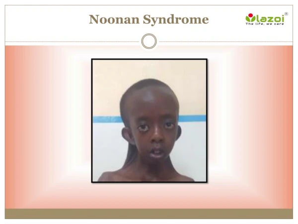 Noonan Syndrome: Causes, Symptoms, Daignosis, Prevention and Treatment