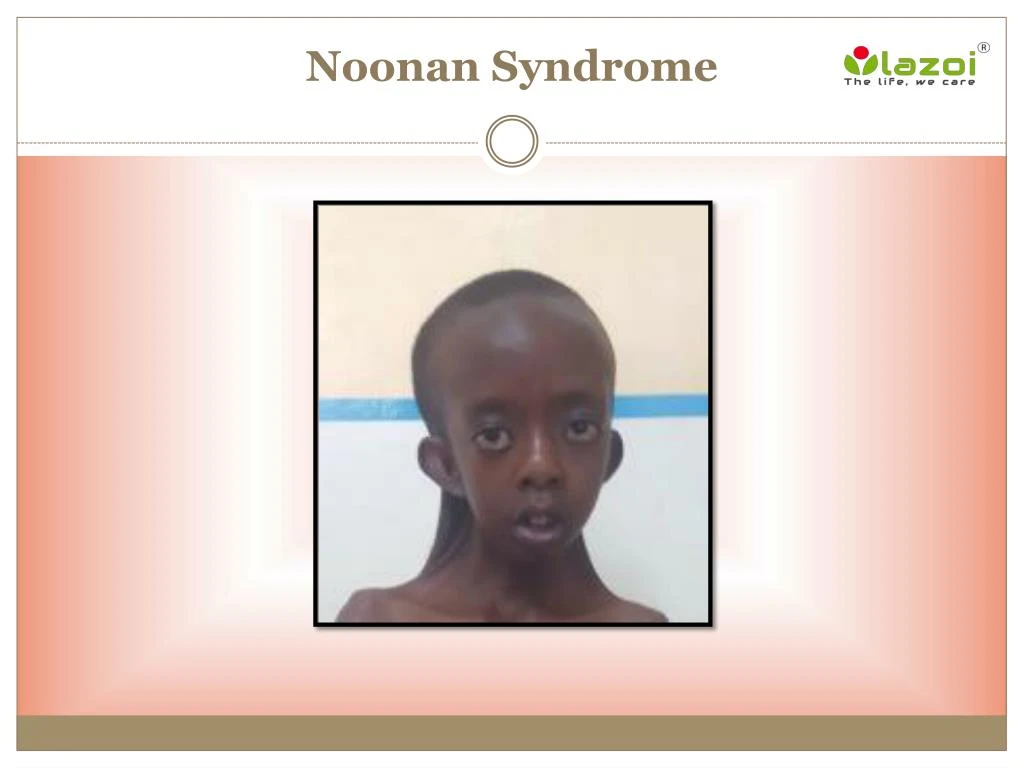 noonan syndrome