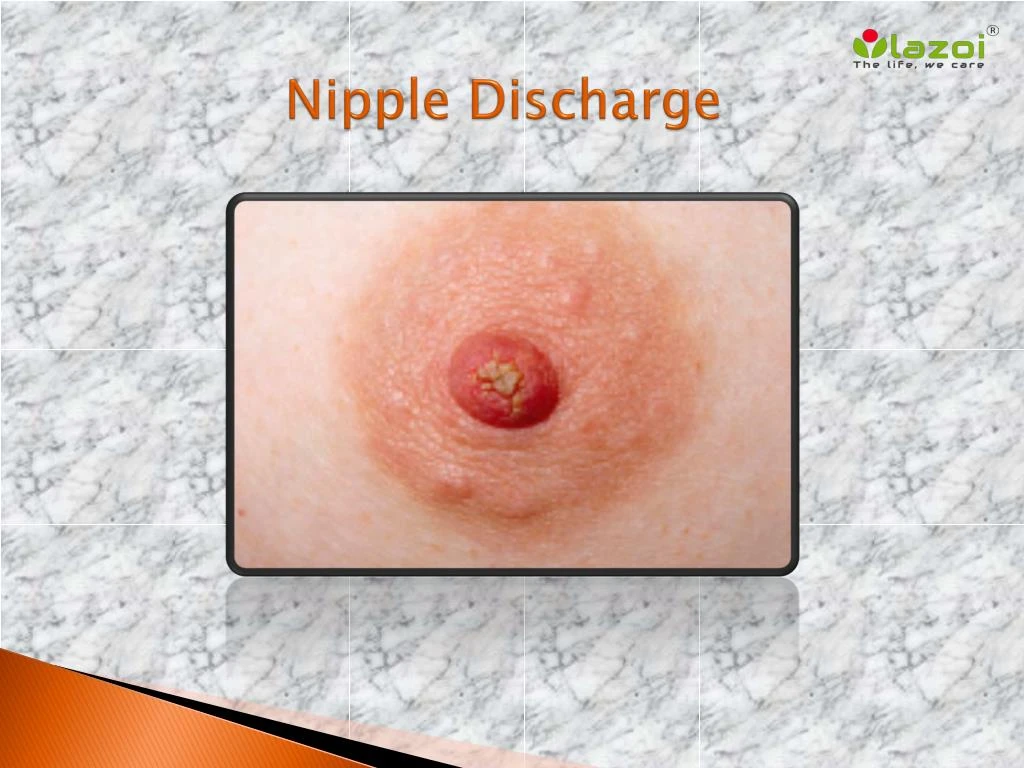 nipple discharge