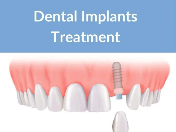 Dental Implants Treatment | New Orchard Dentistry