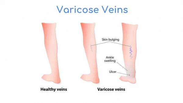 Varicose Vein Treatment
