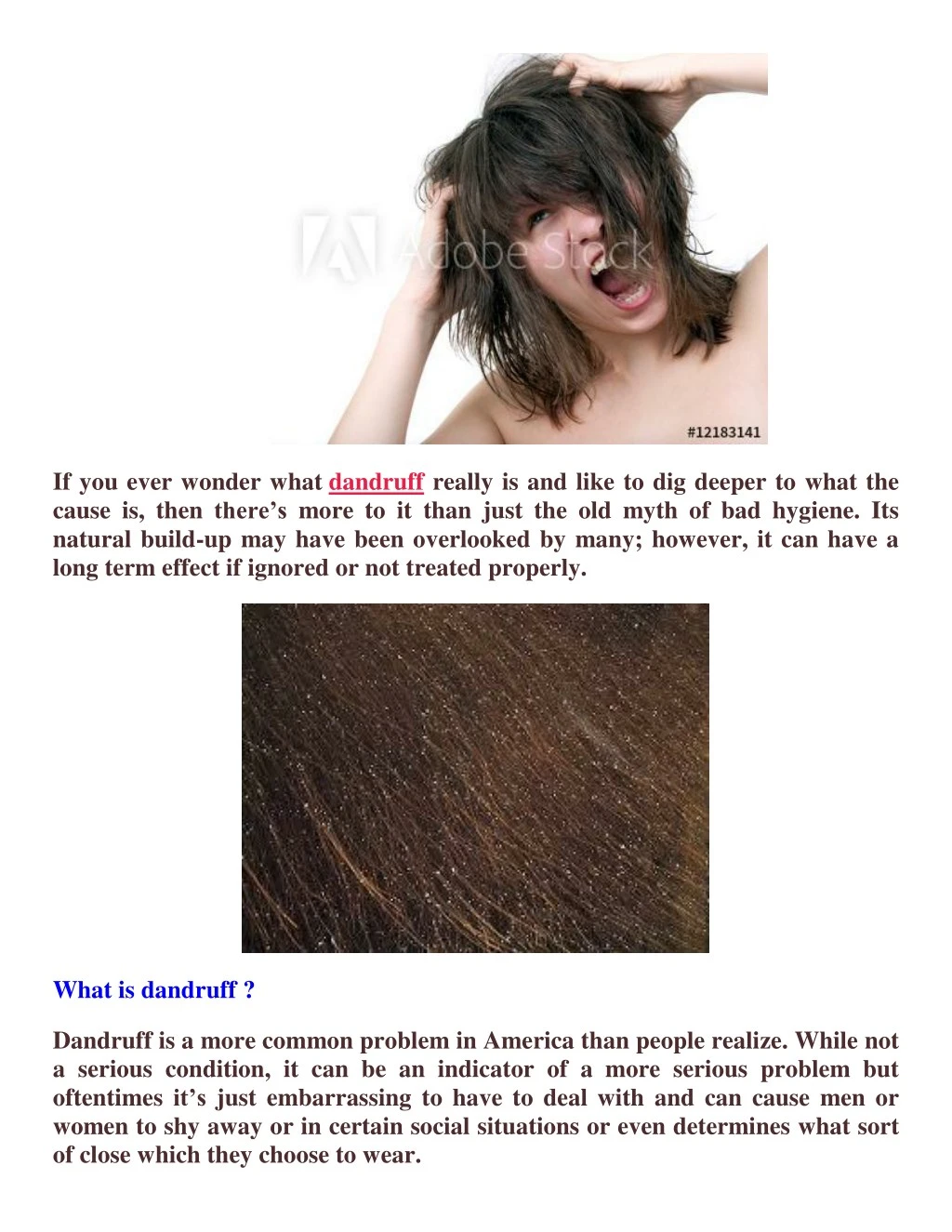 if you ever wonder what dandruff really