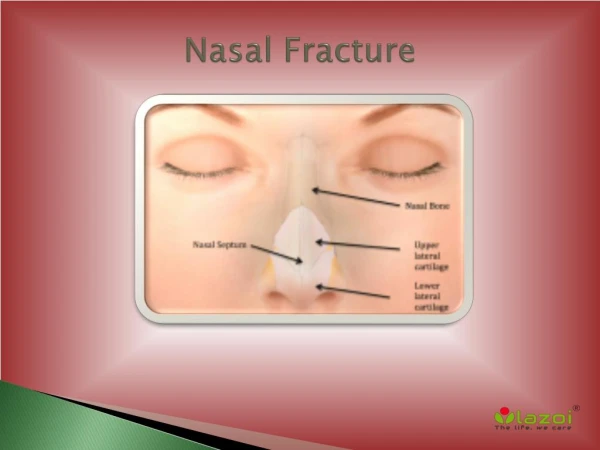 Nasal Fracture : Broken Nose Symptoms, Signs, Surgery & Treatment