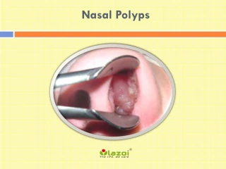 Nasal Polyps: Symptoms, causes, Diagnosis and Treatment