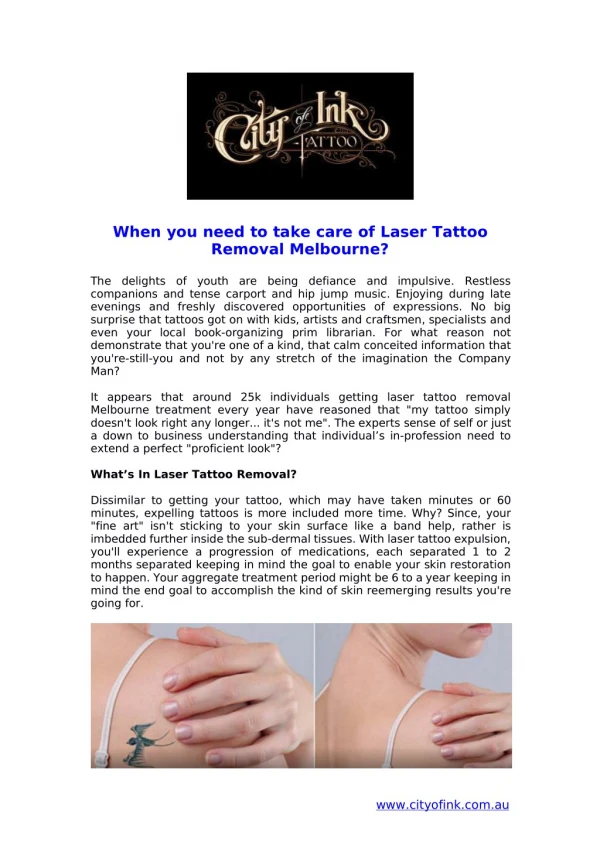 When you have to deal with Laser Tattoo Removal Melbourne?