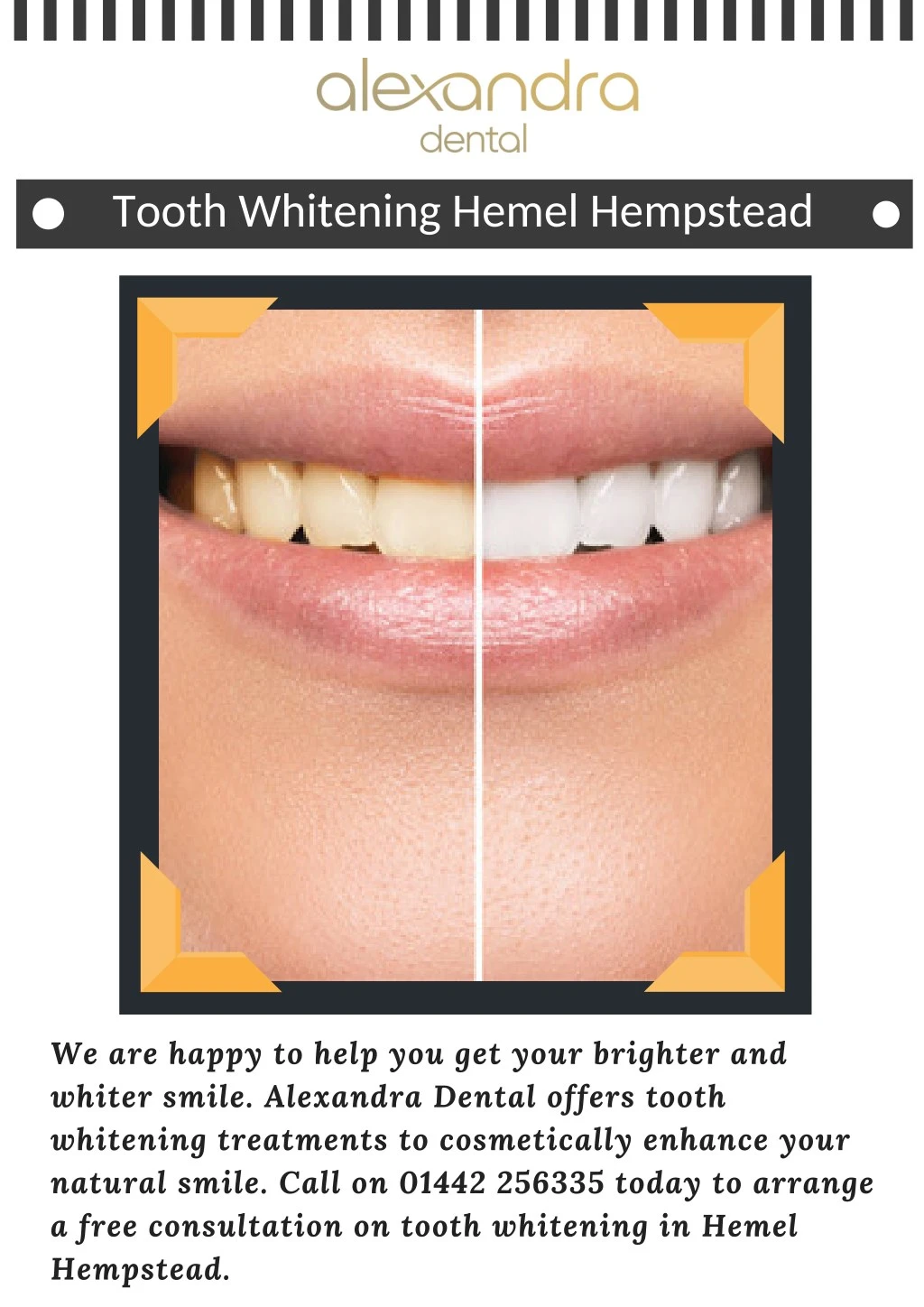 tooth whitening hemel hempstead