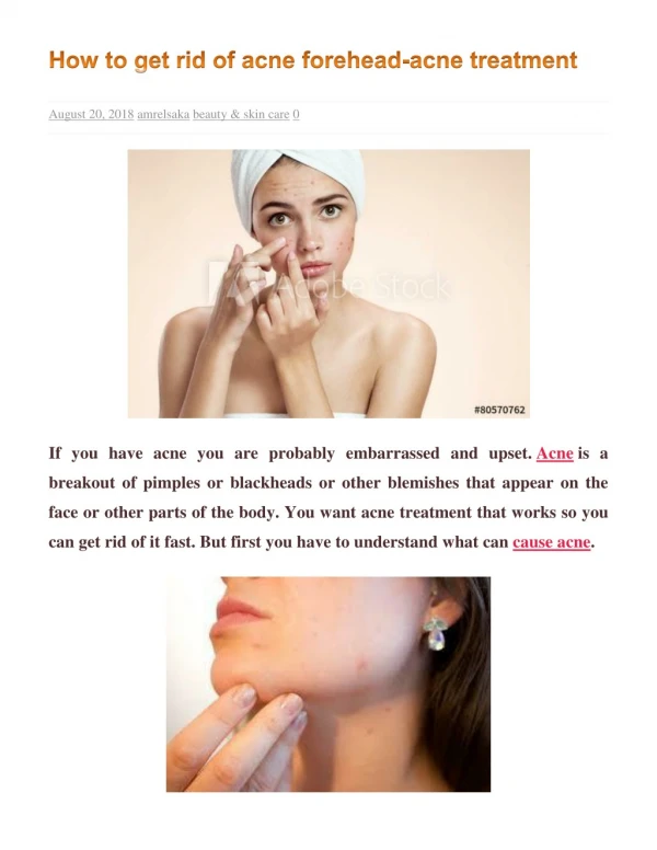 how to get rid of acne forehead- acne treatment